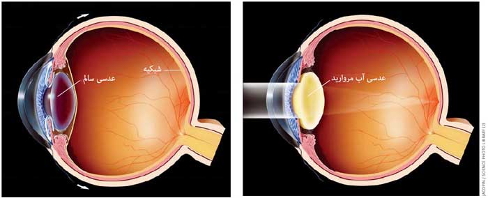 مقایسه چشم سالم و چشم دچار آب مروارید